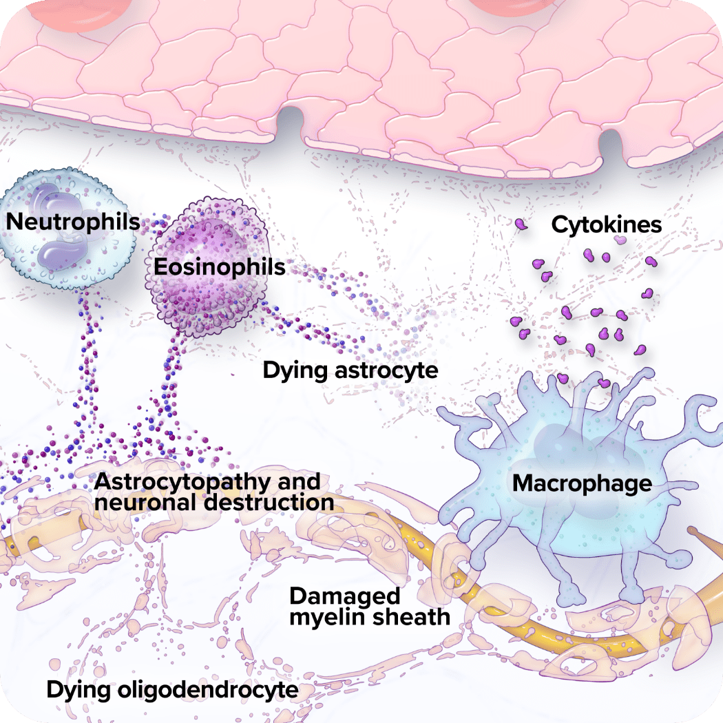 Astrocyte and neuronal death graphic